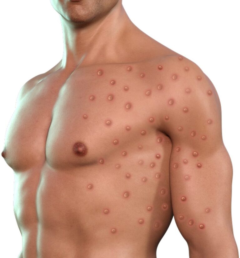 Monkey Pox Has Finally Arrived In The State Of Wyoming First Case in Laramie County Identified